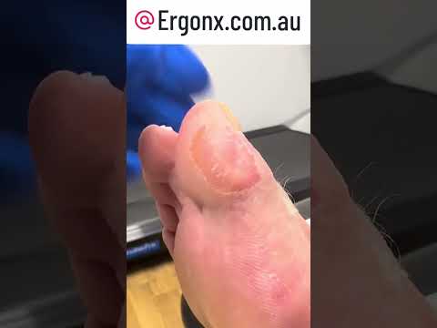 Unbelievable Big Toe Transformation from Steel Capped Boots #ToeCare #CallusRemedy