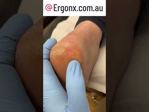 Ultimate Cracked Heel Callus Removal by Expert Podiatrist #Podiatry #FootCare
