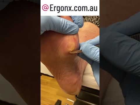 Say Goodbye to Foot Pain Expert Corn and Callus Removal by Top Podiatrist #FootCare #Podiatry