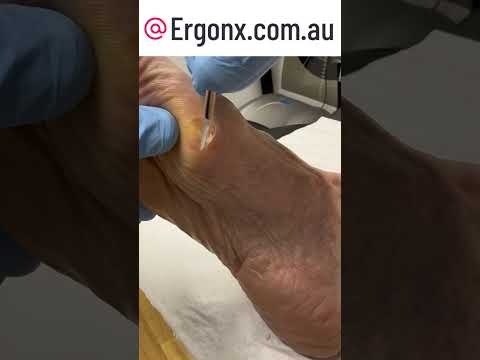 Ultimate Foot Transformation Satisfying Corn & Callus Removal #FootCare #SatisfyingVideos