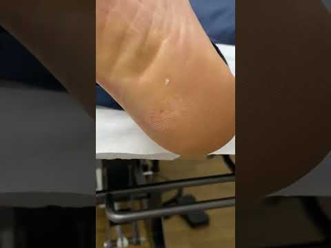 Satisfying Heel Corn Removal by Podiatrist Cutting with Scalpel #Podiatry #FootCare