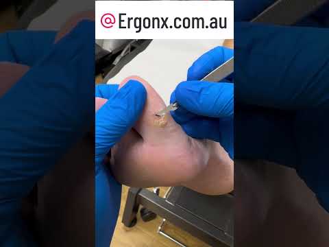 Slow Motion Corn & Callus Cutting on Big Toe #Satisfying #FootCare
