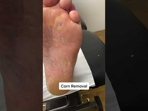 Say goodbye to those painful corns! Watch as this skilled podiatrist works their magic