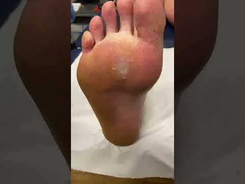 Watch this incredible transformation as a podiatrist works wonders on a deep forefoot callus! 👣✨