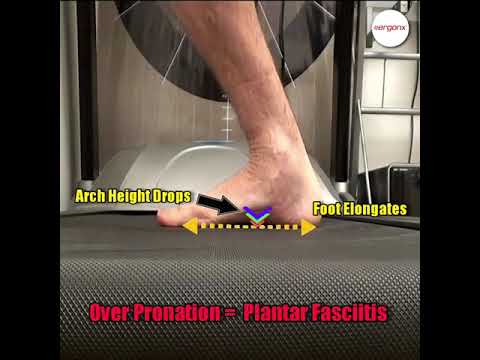 Discover one big culprit behind foot pain: overpronation! 🌟 Learn how it links to those pesky