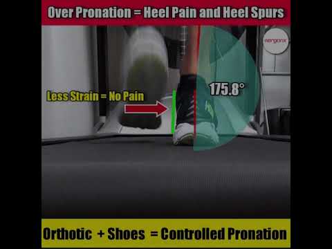 Discover the surprising link between heel pain and overpronation and what you can do about it! 💥👟