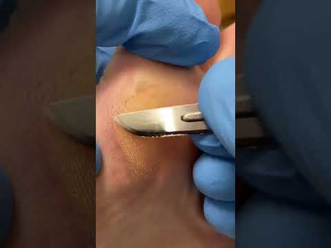 Watch how I tackle thick dry skin on my big toe using a simple but effective routine! 🦶✨ Say