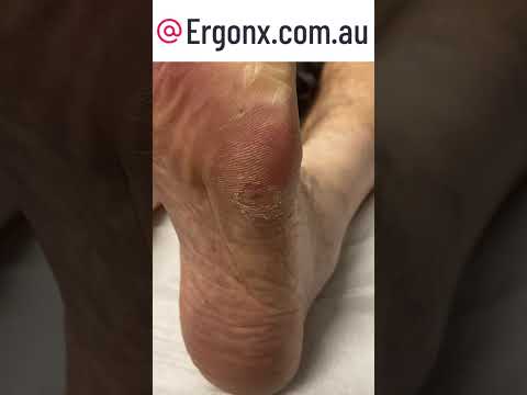 Ultimate Corn & Callus Removal by Podiatrist Expert #FootCare #Podiatry