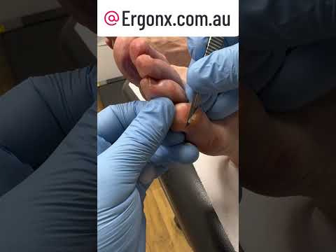 Satisfying Little Toe Callus Removal by Podiatrist #HardSkin #FootCare