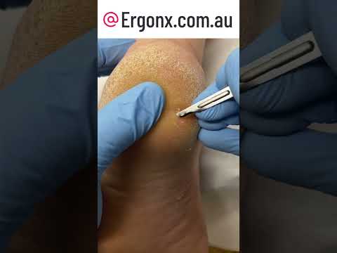 Relieving Heel Pain: Corn Removal by Podiatrist #Podiatry #FootHealth