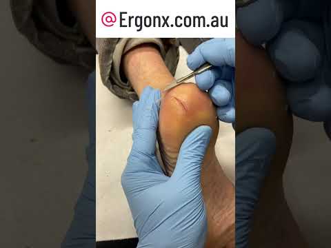 Healing Heel Fissures: Intense Podiatry Treatment #CrackedHeels #FootCare