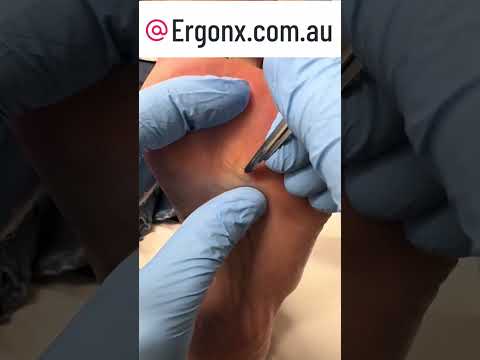 Satisfying Corn Removal Video | Watch This Mesmerizing Process #SatisfyingVideo #FootCare