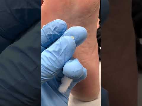 Podiatrist's Guide to Painless Corn Removal #FootCare #Podiatry