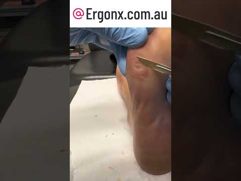 Ultimate Corn Removal: Watch a Scalpel Work Magic in the Podiatry Clinic #FootCare #Podiatrist