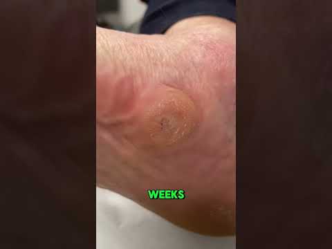 When tendon problems are ignored for too long… the foot can start to collapse