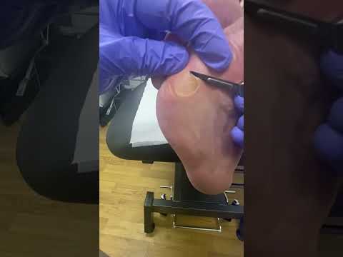 Watch us transform your feet with expert corn and callus removal! Say goodbye to discomfort and