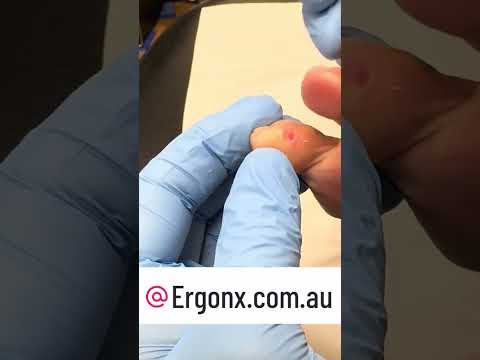 Podiatrist Removes Painful Interdigital Corns Unbelievable Transformation #FootCare #Podiatry