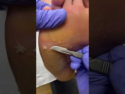 "Watch as a skilled podiatrist works magic! Say goodbye to deep cracked skin and hello to smooth