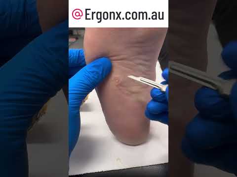 Satisfying Corn Removal by Australian Podiatrist ASMR Foot Care #Podiatry #FootHealth