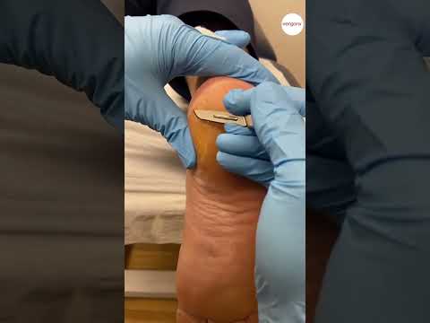 Reducing Thick Callus Around the Edge of the Heel
