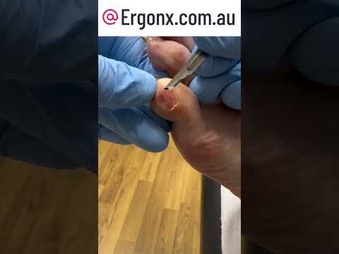 Say Goodbye to Calluses: Watch a Little Toe Transformation! #Podiatry #CallusRemoval