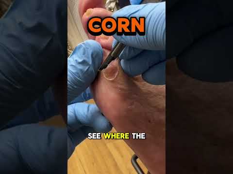 👣 Case Spotlight: Fifth Toe Corn Debridement This patient presented with a large corn on the fifth
