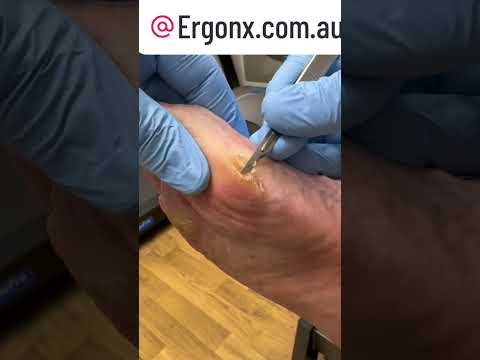 Pain Relief: Watch a Podiatrist Use a Scalpel for Callus Removal #Podiatry #FootCare