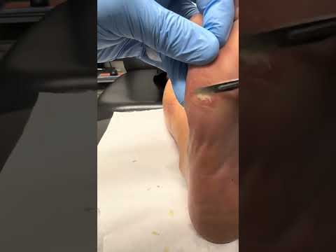 Painless Corn Removal on Forefoot Satisfying Procedure Reveal #FootCare #Podiatry