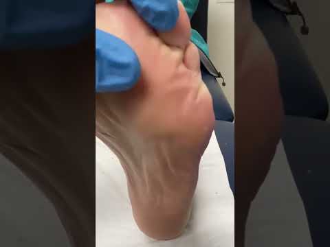 Transform your feet and step into comfort! 🦶✨ Watch this satisfying forefoot and general callus