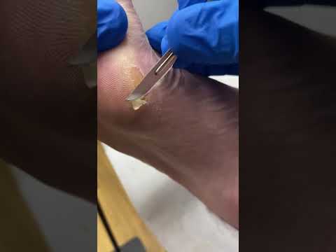 Say Goodbye to Painful Bunions and Calluses: Expert Podiatrist Tips #BunionRemoval #Podiatry