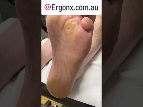 Podiatrist's Guide to Corn Removal and Ulcer Relief Transformation #FootCare #Podiatry