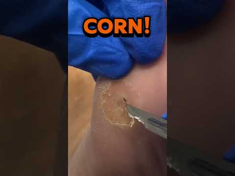 Painful to walk on… but painless to remove 👇 This plantar hard corn sits under the 5th metatarsal