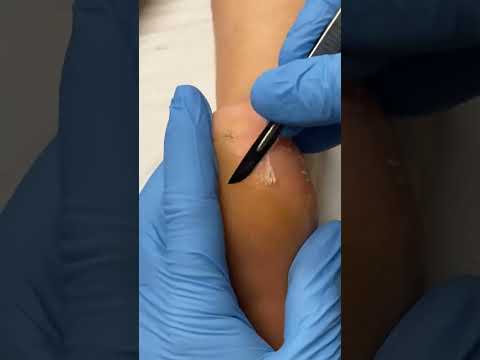 Say goodbye to stubborn heel calluses! Watch as a skilled podiatrist works their magic to reveal