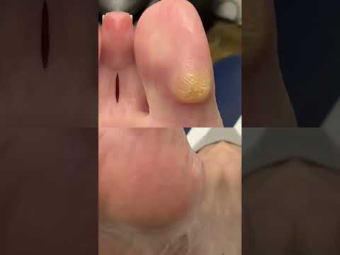 Transform your step game! 🌟 Discover the ultimate remedy for that stubborn big toe callus