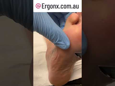 Amazing Foot Transformation Watch Podiatrist Remove Thick Callus #FootCare #Podiatry