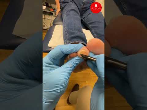 Ulcerated Toe Corns: Why Professional Care Matters