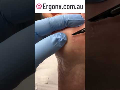 Corn Removal by Podiatrist: Satisfying Foot Transformation #Podiatry #FootCare