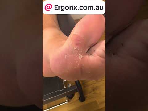 Big Toe Callus Removal and Foot Pressure Guide