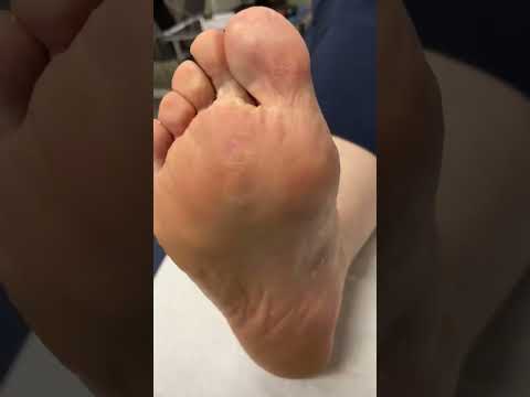👣 Watch this insanely satisfying corn removal by a skilled podiatrist! Say goodbye to foot pain and