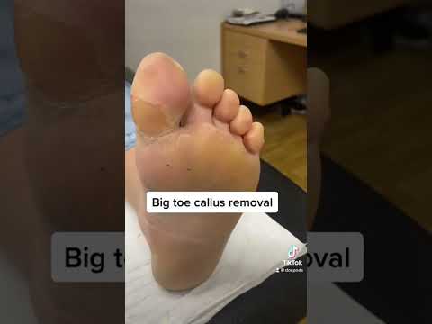 Say goodbye to tough toe skin! Watch how I transform my feet with this amazing technique