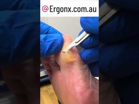 Work Boots Woes: How to Fix Big Toe Calluses Fast #FootCare #WorkBoots