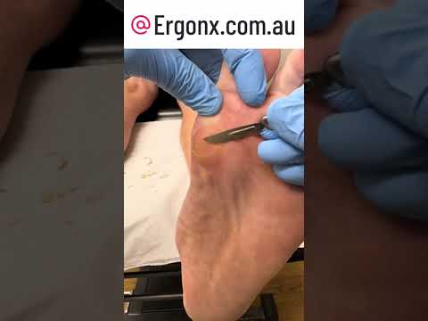 Satisfying Callus Removal in Podiatry Clinic Watch Forefoot Scalpel Skills #Podiatry #FootCare