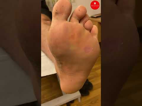 Forefoot Callus Removal: Causes & Professional Care
