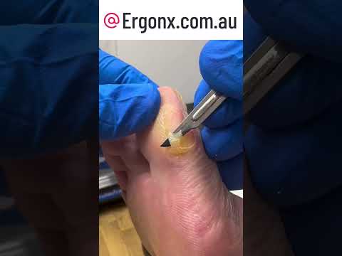 Satisfying Thick Big Toe Callus Removal by Podiatrist #CallusRemoval #FootCare