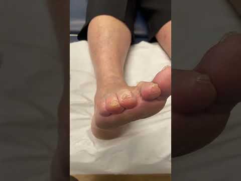 Transforming toes from rugged to radiant! Watch this satisfying callus removal and give your feet