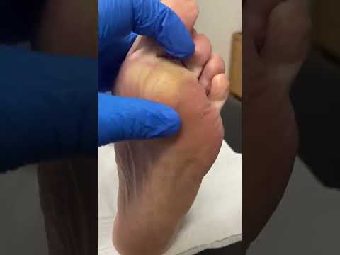 Satisfying Callus Removal in Australia: Foot Transformation by Podiatrist #FootCare #Podiatry