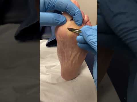 Say goodbye to stubborn calluses on the ball of your foot! 🌟 Witness the transformation and learn