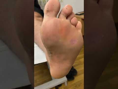Watch this incredible transformation as we tackle a thick forefoot callus! Say goodbye to discomfort