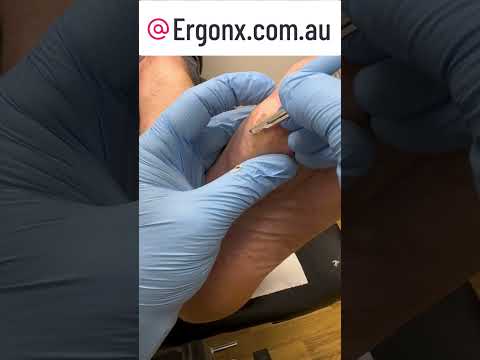 Satisfying Slow Motion Foot Callus Cutting ASMR #OddlySatisfying #FootCare