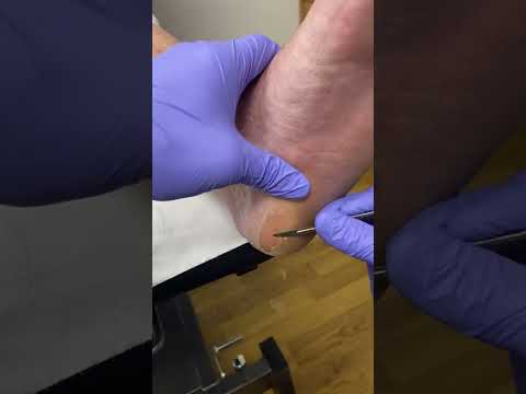 Watch the satisfying transformation as tough calluses disappear! Say goodbye to hard skin and hello